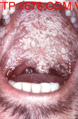 Bệnh nấm candida miệng